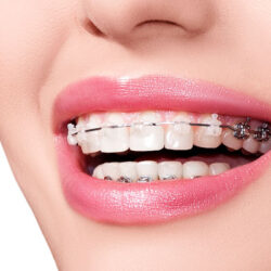 Zahnfarbene Minibrackets