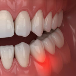 Chirurgische Parodontitistherapie