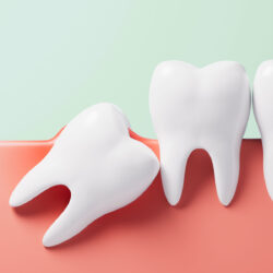 Weisheitszahnentfernung