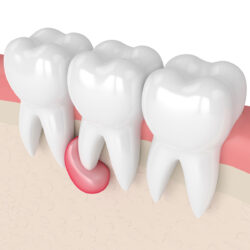 Wurzelspitzenresektion